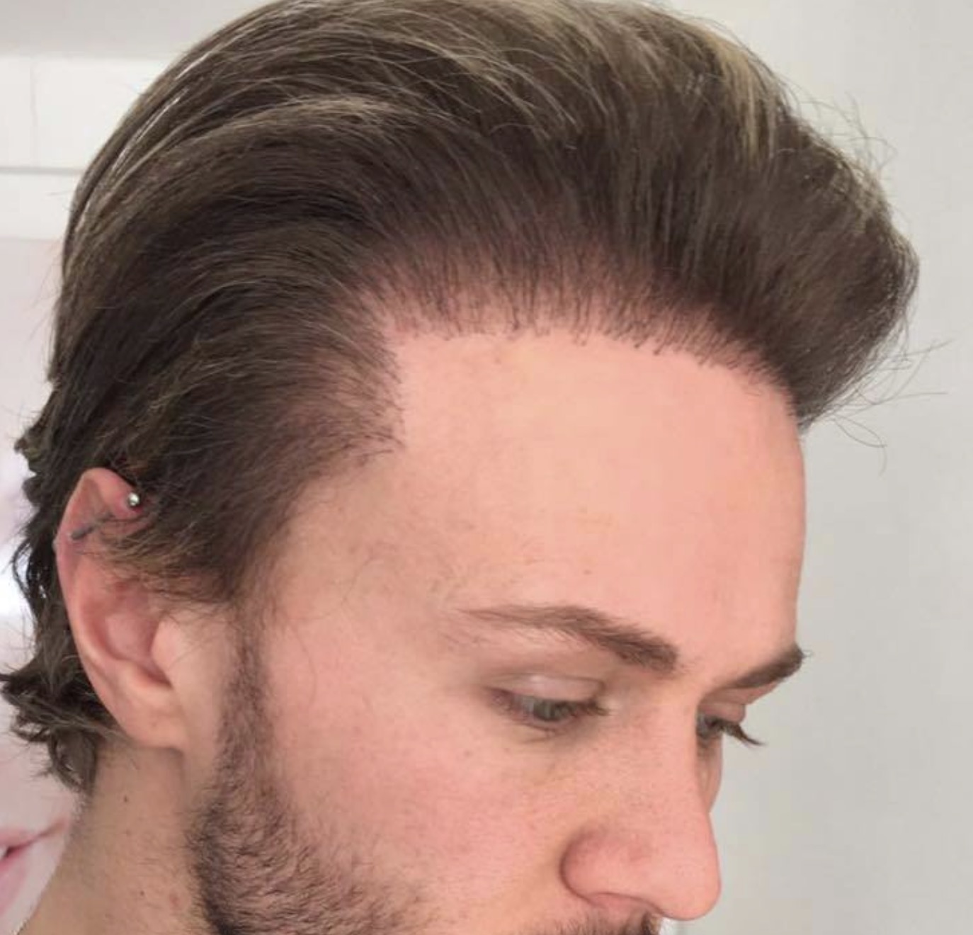 Unnatural hairline